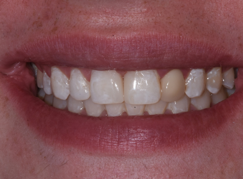 actual patient composite bonding after