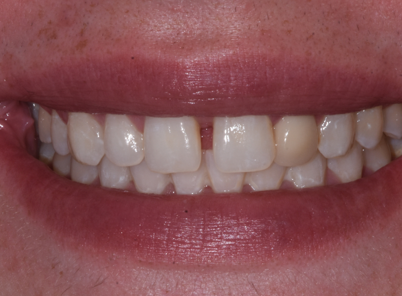 actual patient composite bonding before
