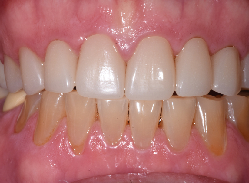actual patient Upper Arch Rehab after