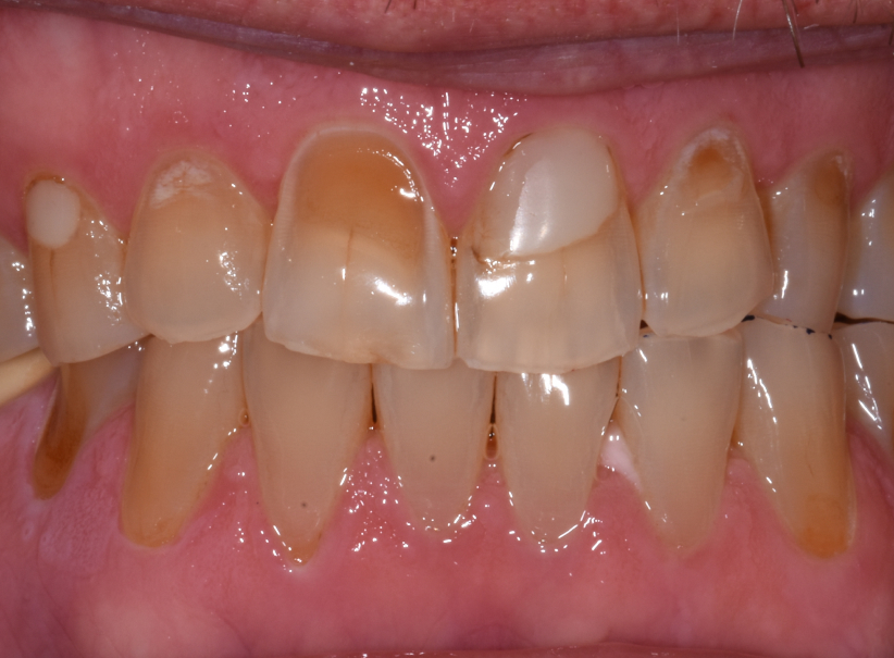 actual patient Upper Arch Rehab before