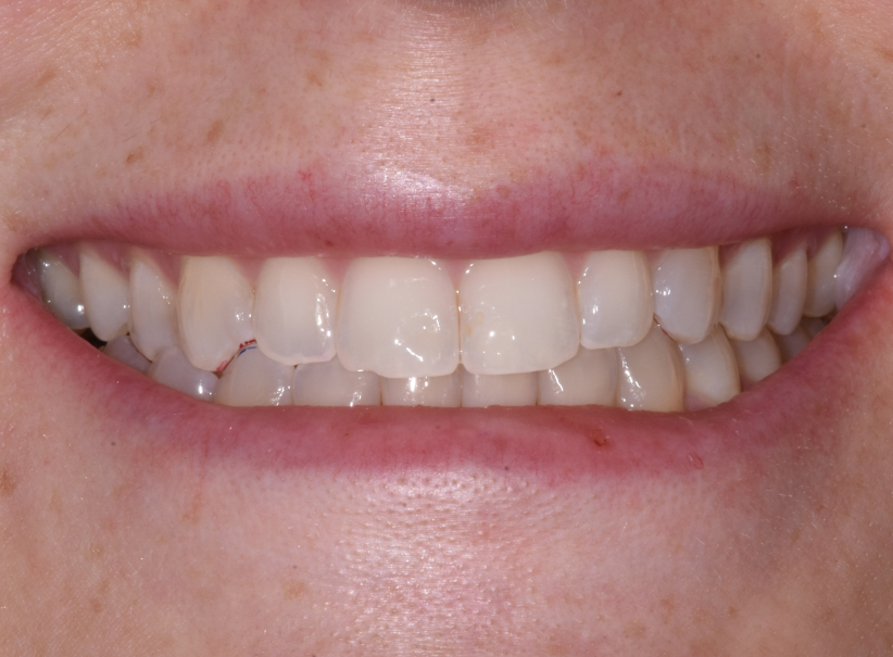 actual patient invisalign after