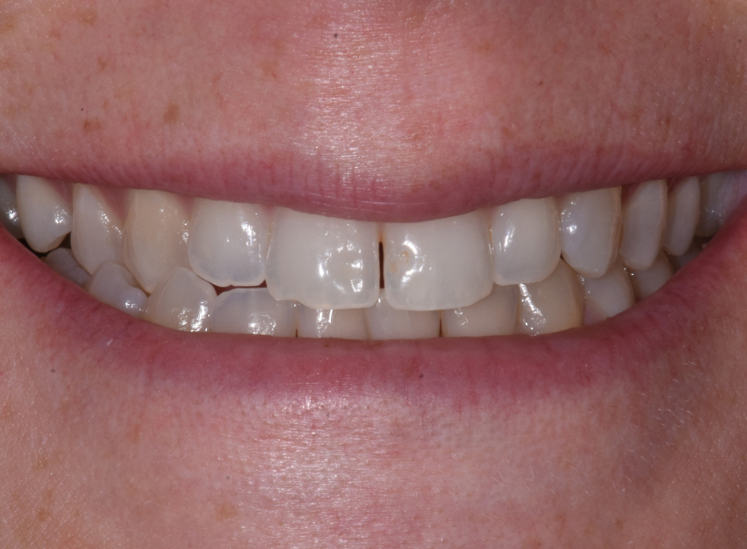 actual patient invisalign before