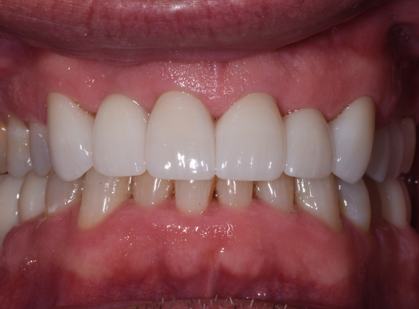 actual patient crowns after