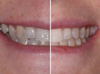 patient before after